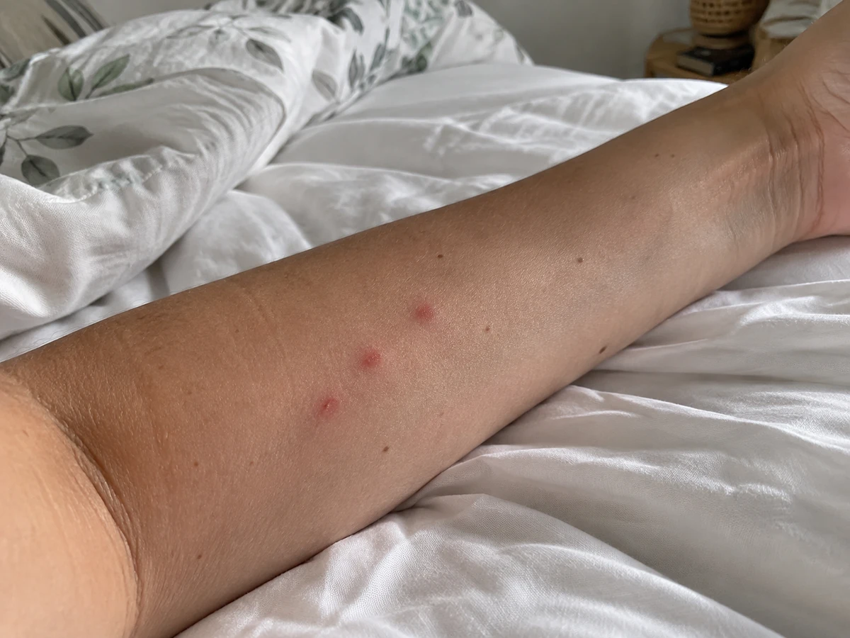 Boutons alignés par trois ou quatre au réveil : photo d’identification (punaises de lit)